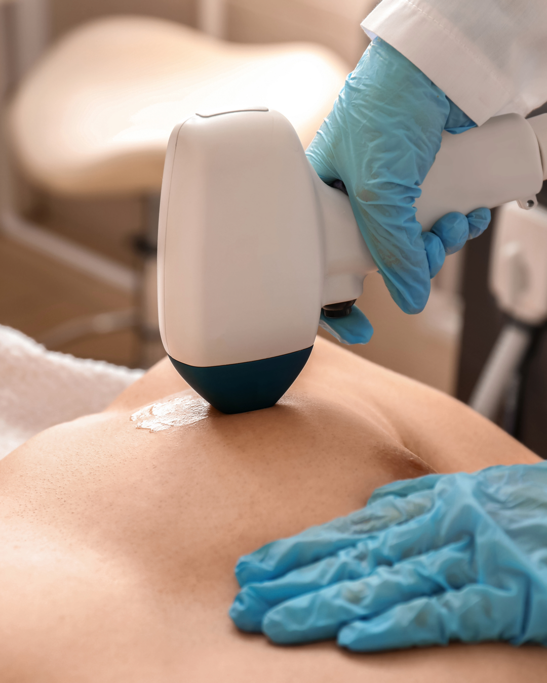 Depilación láser soprano ice en el pecho